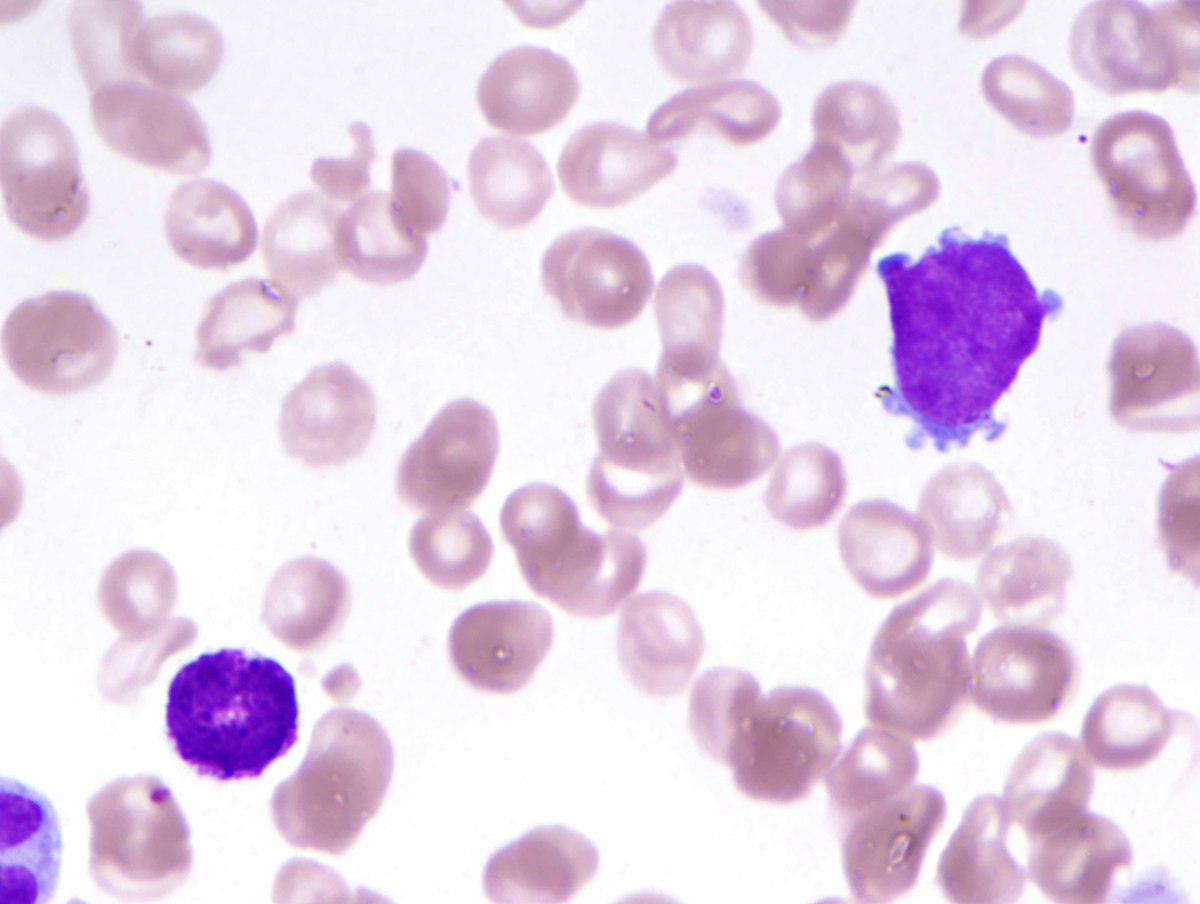 C) Aspicular bone marrow aspirate with scattered blasts and basophils (Wright stain, 1000x oil)